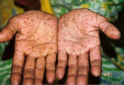 lesions